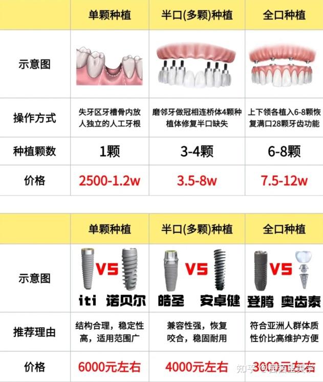 全口种植牙价钱图片