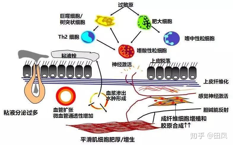 季節性發病或接觸刺激性氣味即出現憋氣,嗆咳難忍等氣道高反應性症狀