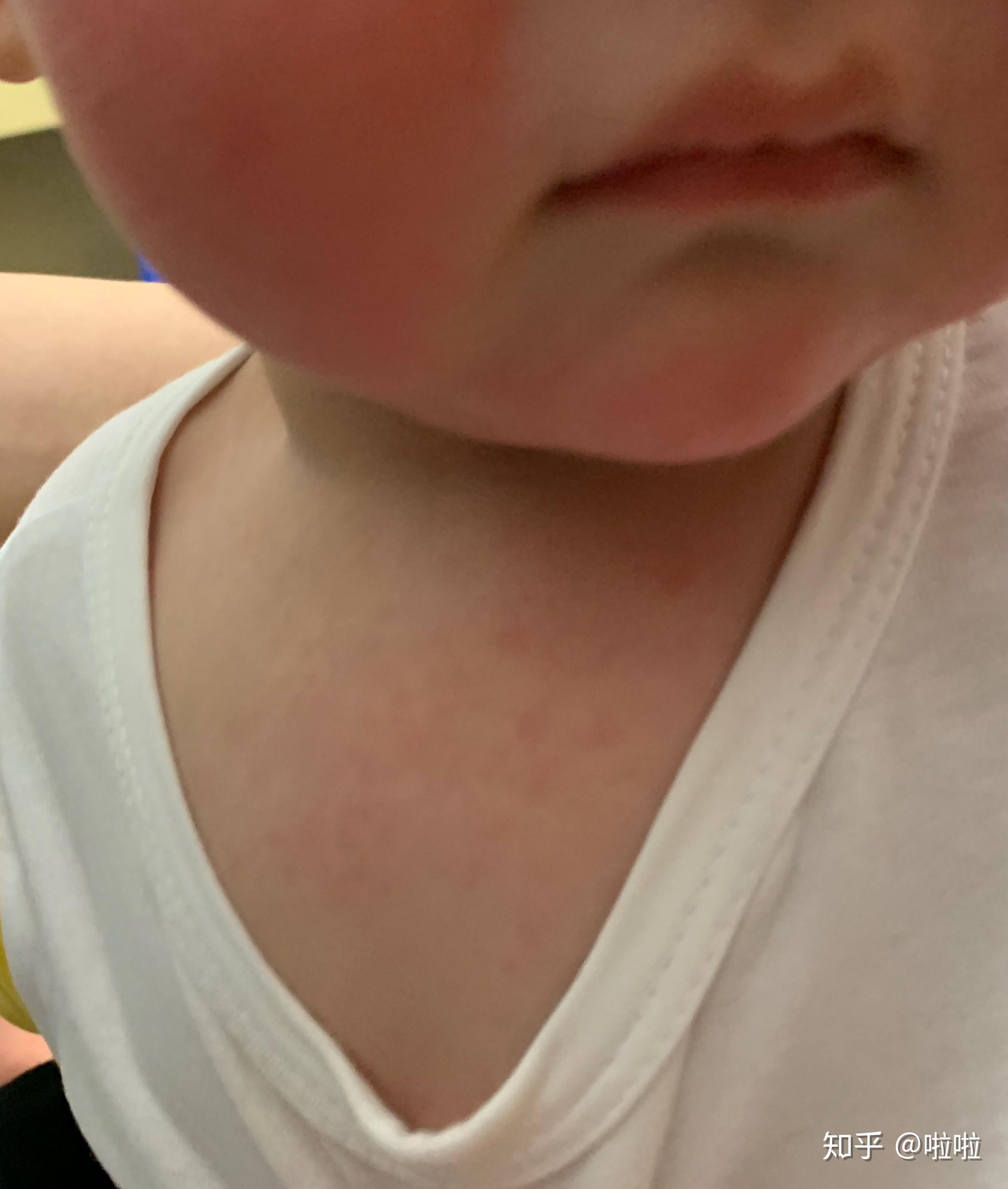 幼儿急疹子的症状图片图片
