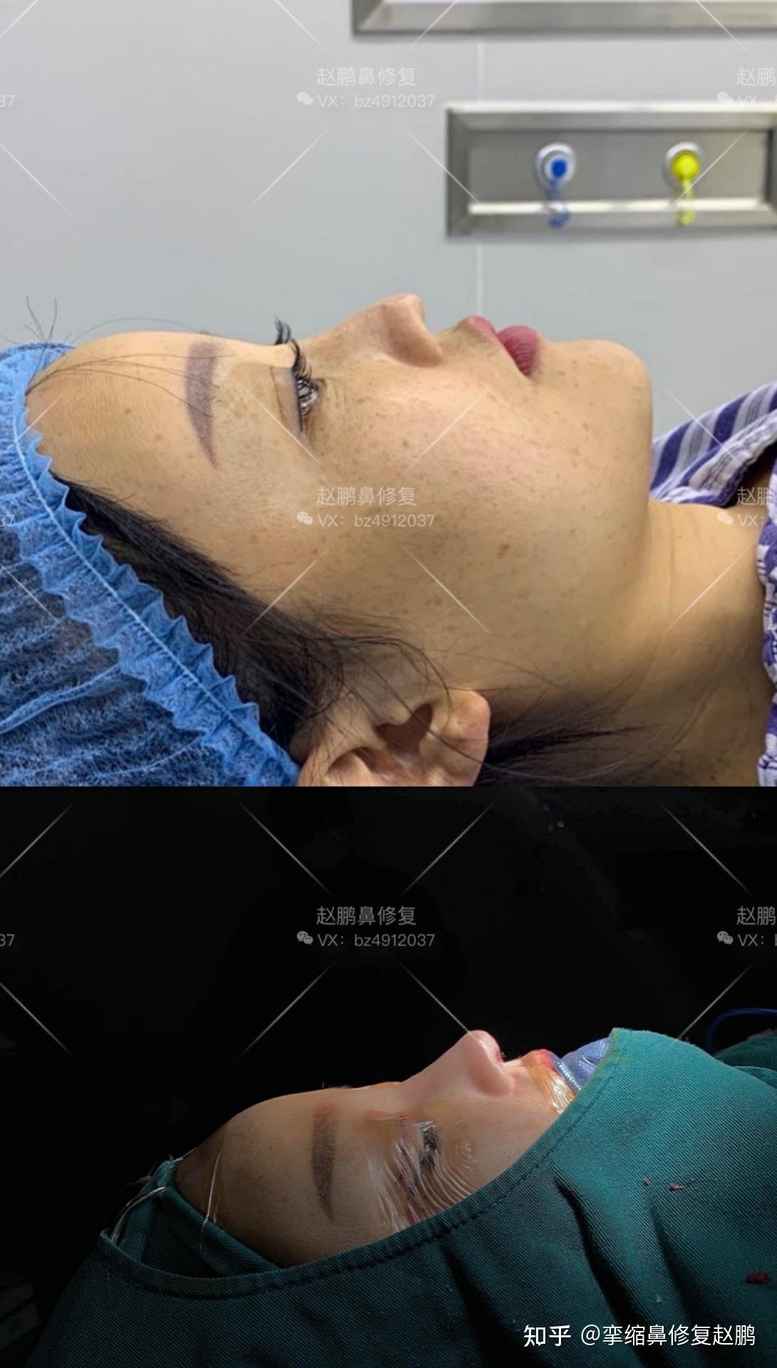 鼻小柱凹陷鼻翼缘退缩修复案例分享