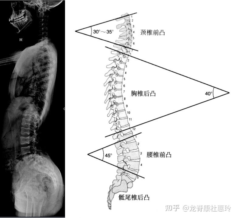 警惕加重脊柱侧弯的“平背”!学会3个动作帮助恢复生理曲度 - 知乎