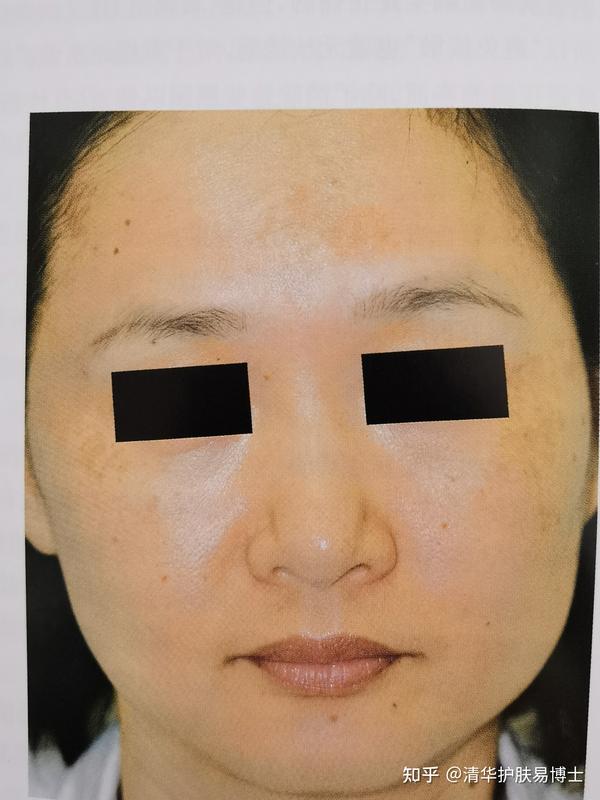 “斑中之王”——黄褐斑之《中国黄褐斑治疗专家共识(2021)》解读 知乎