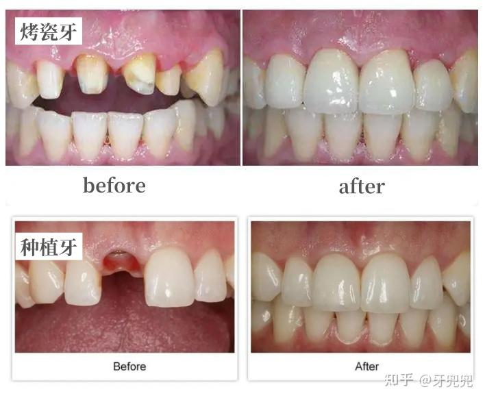种植牙医院和医生怎么选?