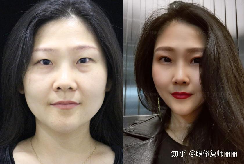 典型的细长型东方眼适合什么双眼皮?