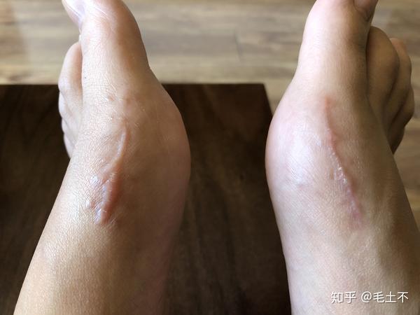 希望脚趾们能早日恢复往昔活力!