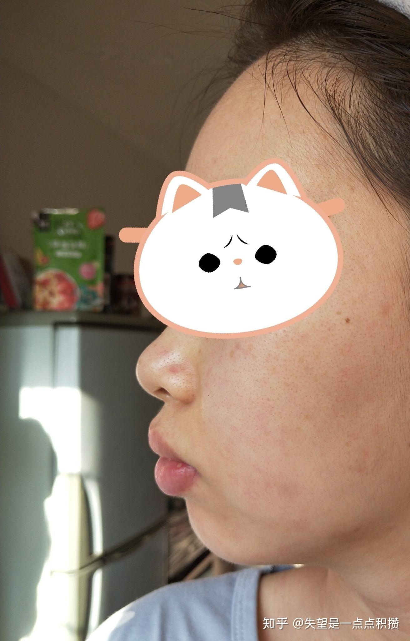 龅牙做完矫正后会有什么改变