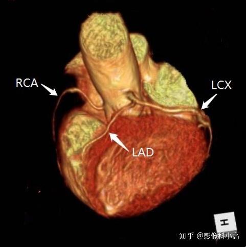 心影科普无创冠脉mra案例分享