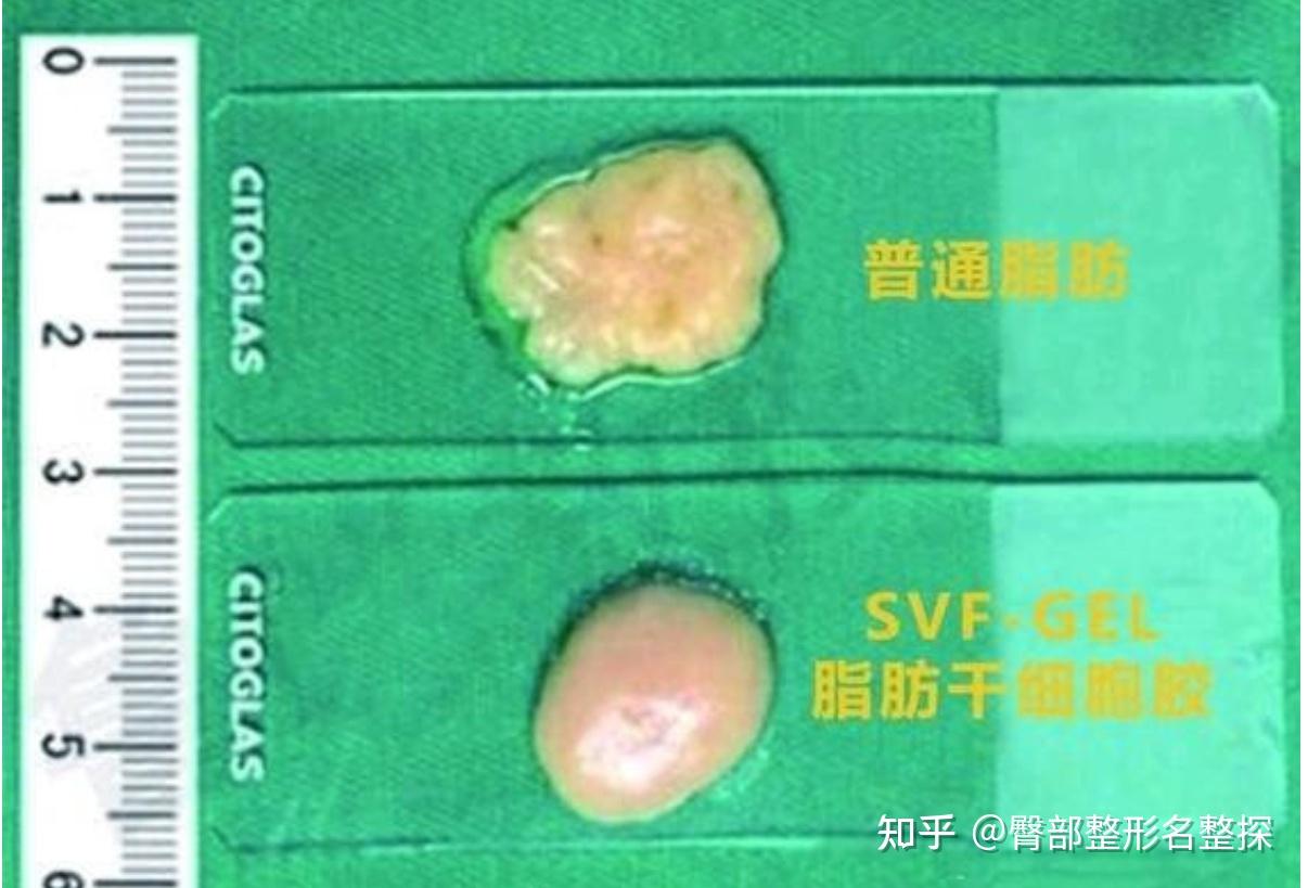 大颗粒脂肪，小颗粒脂肪，纳米脂肪和svf脂肪胶的区别 - 知乎