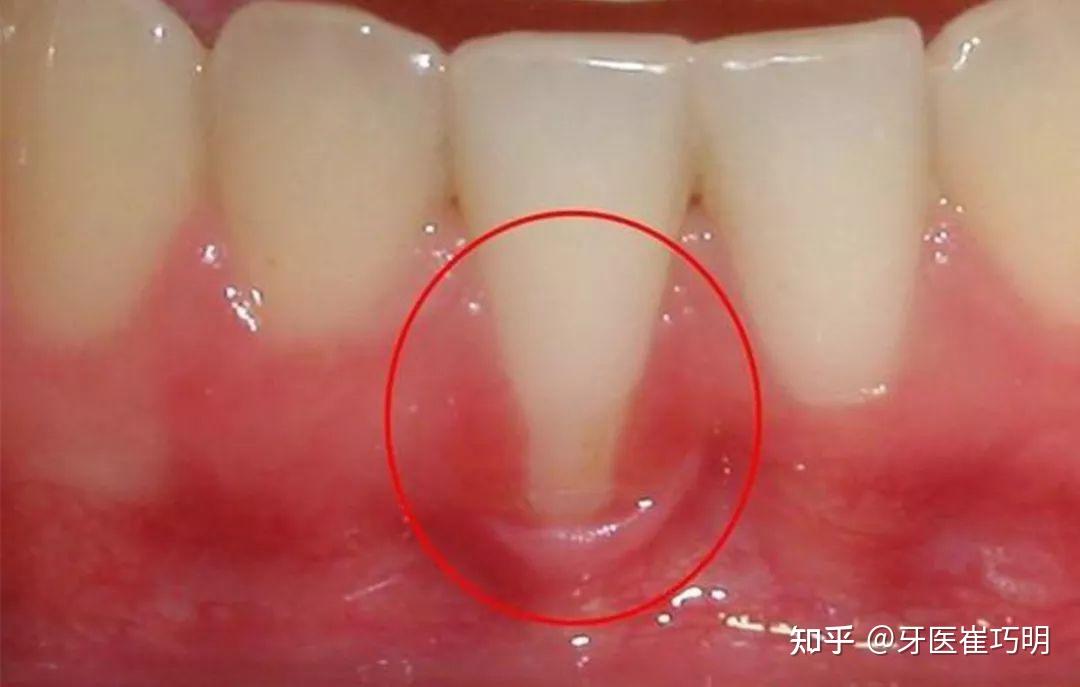 6,有氟斑牙,四环素牙,这些会造成牙釉质发育不全,引起牙本质暴露从而