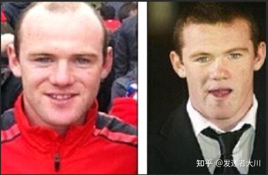 鲁尼用自己的植发经历,告诉你多年后是否和刚植发时效果一样!