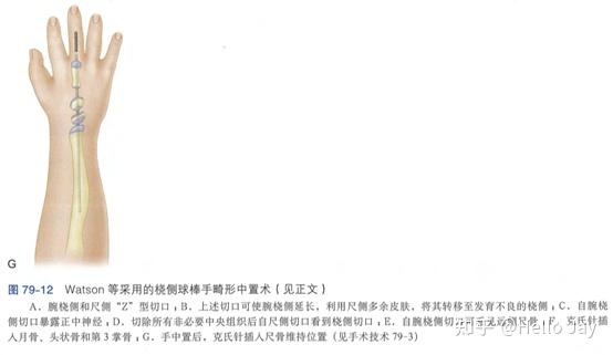 先天性手部畸形-形成障碍(发育停止) - 知乎