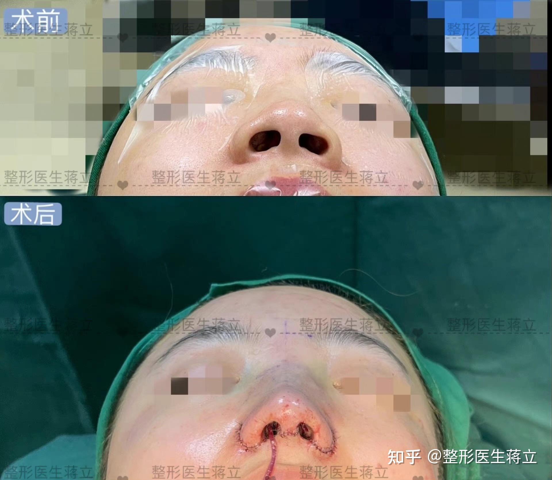 【鼻翼外扩以及其分型①】整形医生蒋立