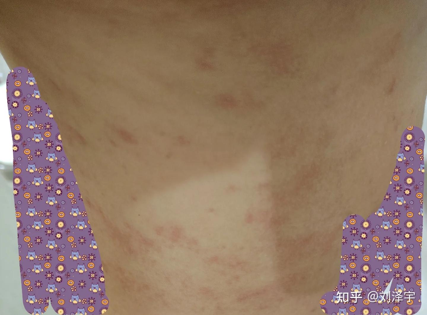 男生私密处和大腿根起一些红色的疹子还很痒是怎么回事? - 知乎