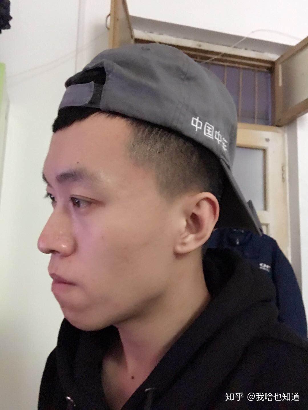 牙齿地包天兜齿是怎样的一种体验