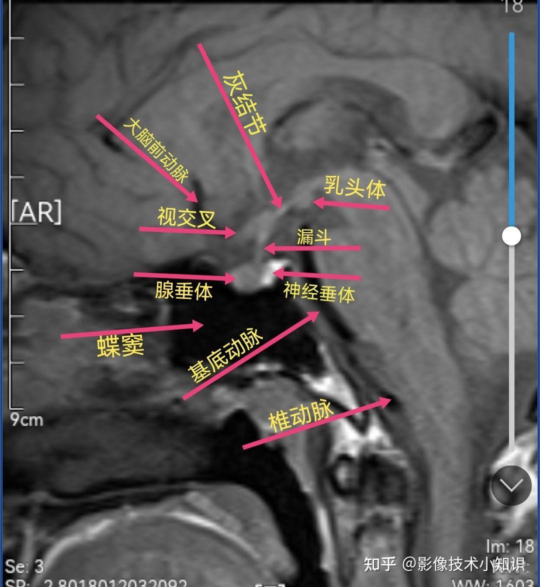 鞍区mri影像解剖