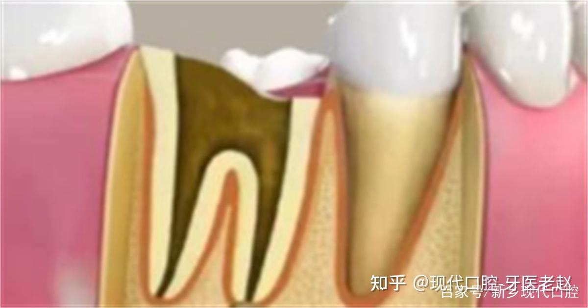 残冠,残根要不要拔除 - 知乎
