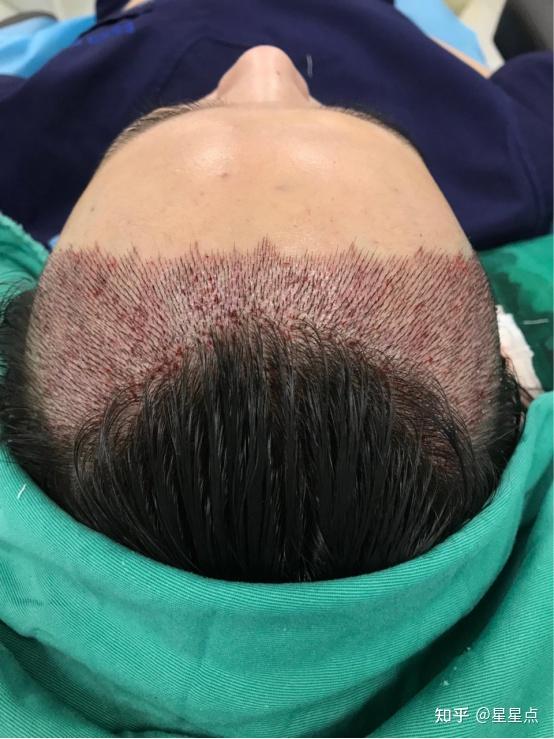 大麦微针植发前后经过分享看看值不值