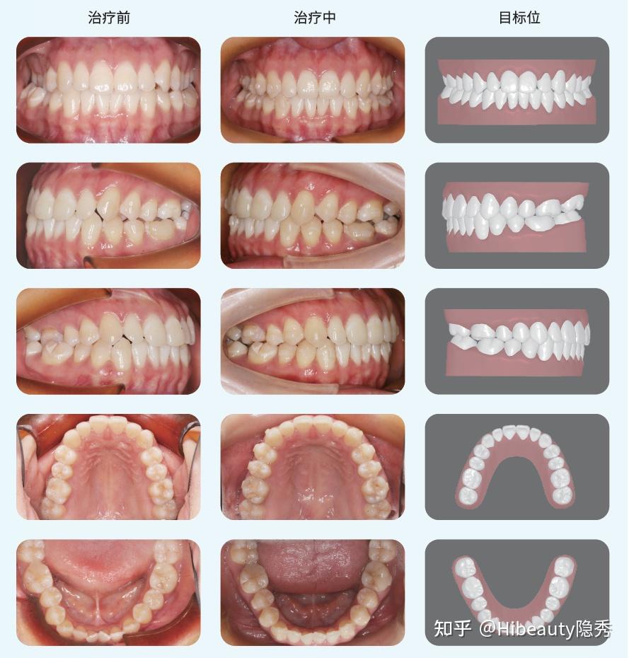 hibeauty隐秀「牙列拥挤/上牙弓狭窄/后牙反合 /骨性扩弓 隐形矫治器
