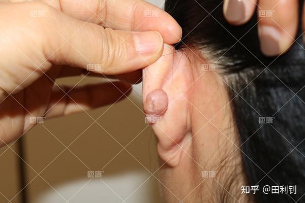 耳朵缝针后恢复图片图片