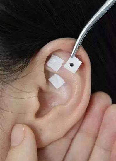 "耳穴疗法"让近视的孩子"看清"世界