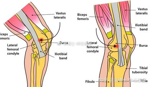 髂胫束摩擦综合征的损伤原因