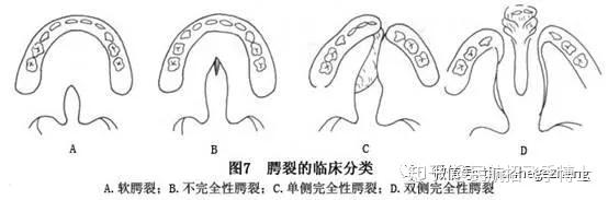 分，各向两侧斜裂，直达牙槽突；鼻中隔、前颌突及前唇部分孤立于中央。