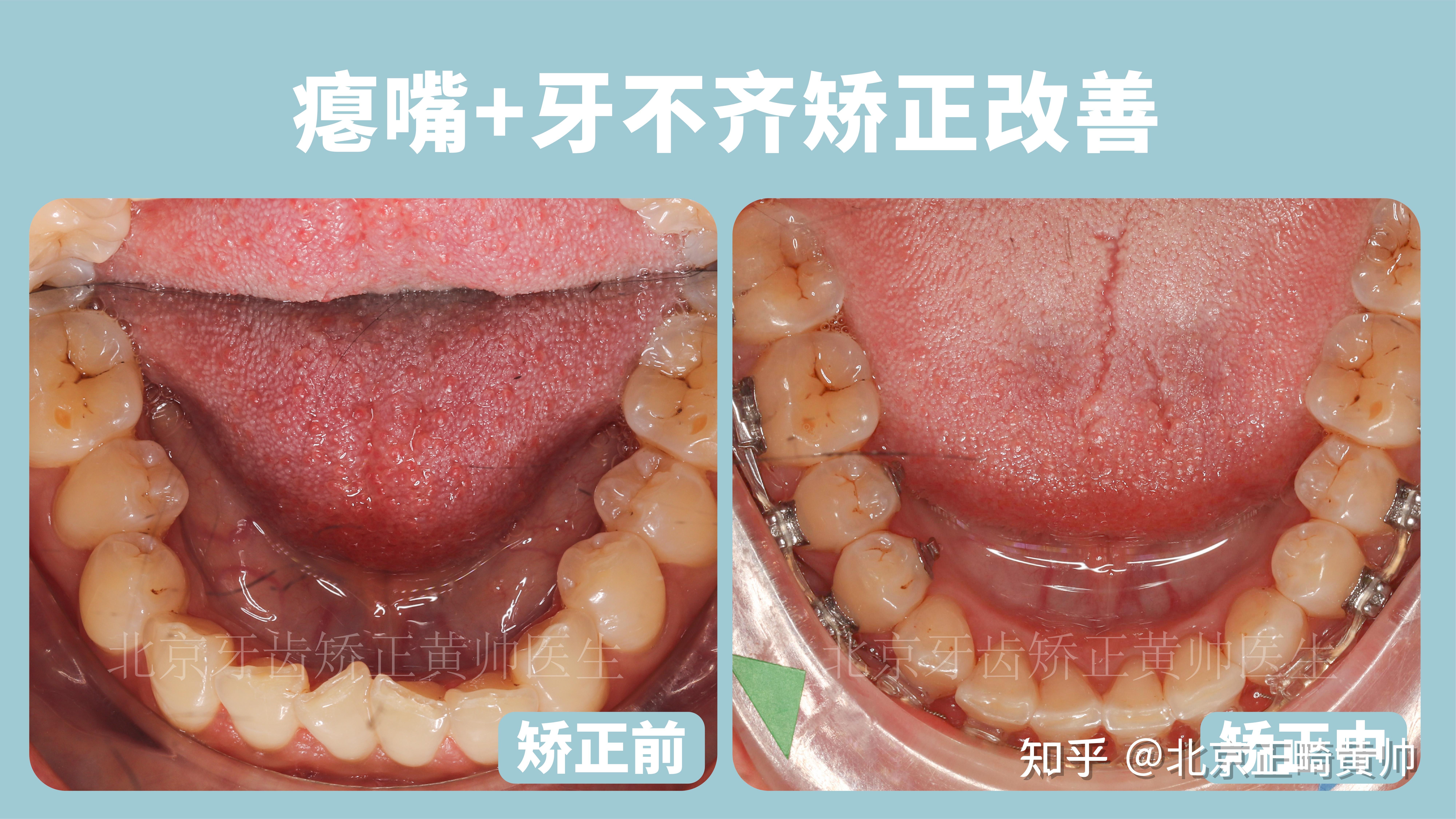 因为这几种牙齿角度会影响面型!