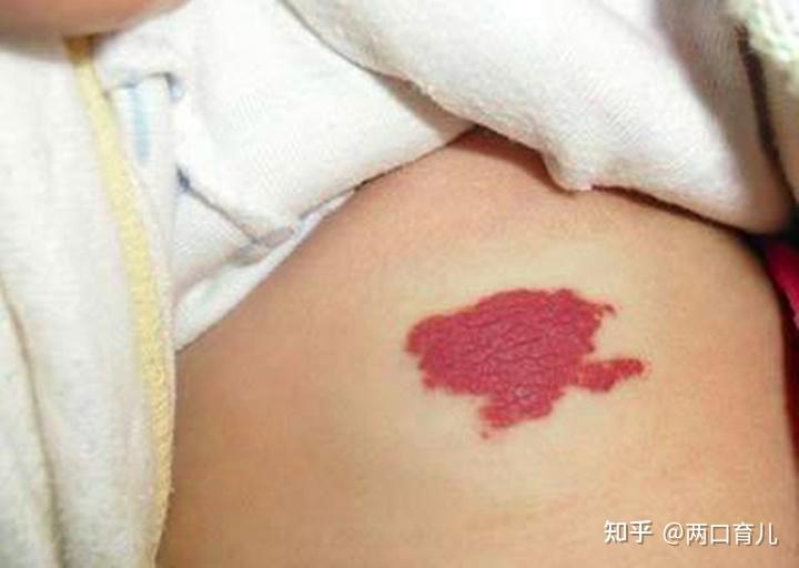 为什么宝宝会长胎记除了遗传因素孕期的2个原因更需要注意