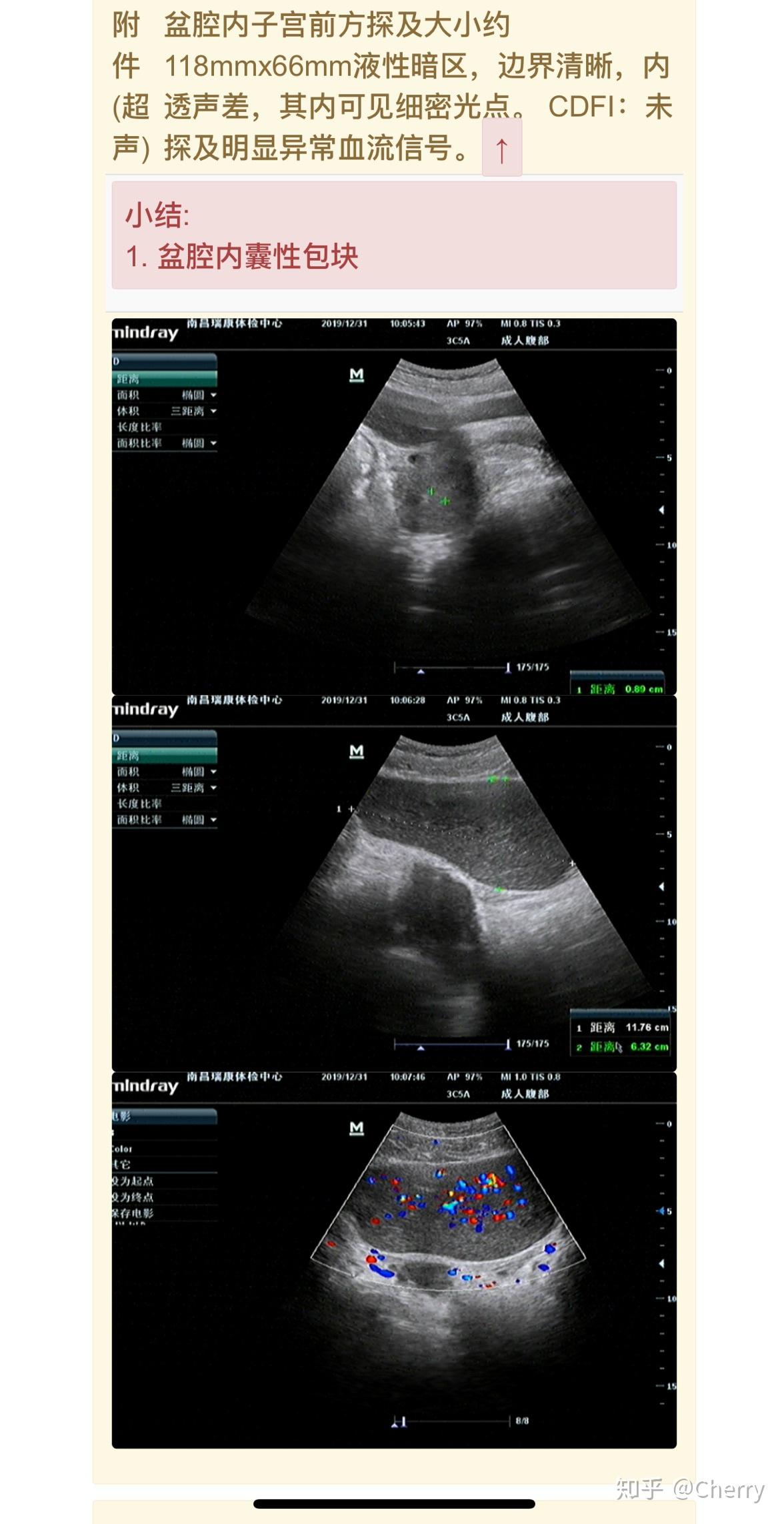 【腹腔镜篇】卵巢囊肿剥除术 - 内窥镜摄像系统 - 上海世音光电仪器有限公司