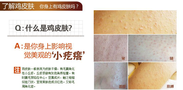 关于鸡皮肤会不会体检不合格的信息