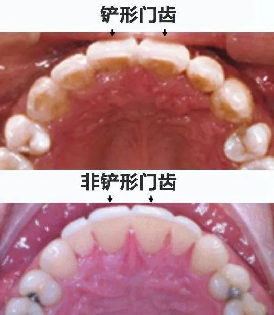 中国人的门牙像个小铲子，是为了更好吃饭吗？ - 知乎