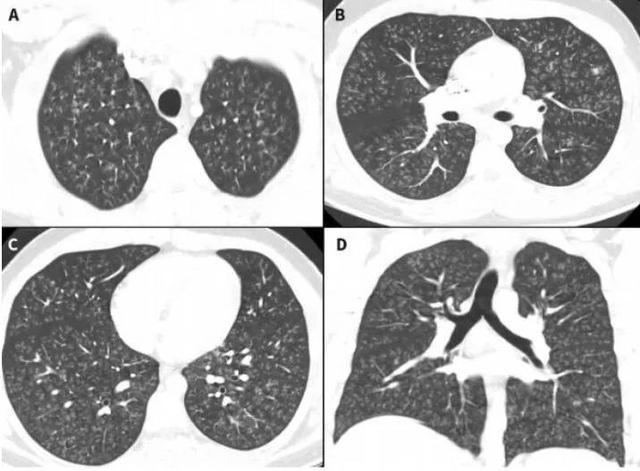 谁干的17岁少年的肺被炸成爆米花