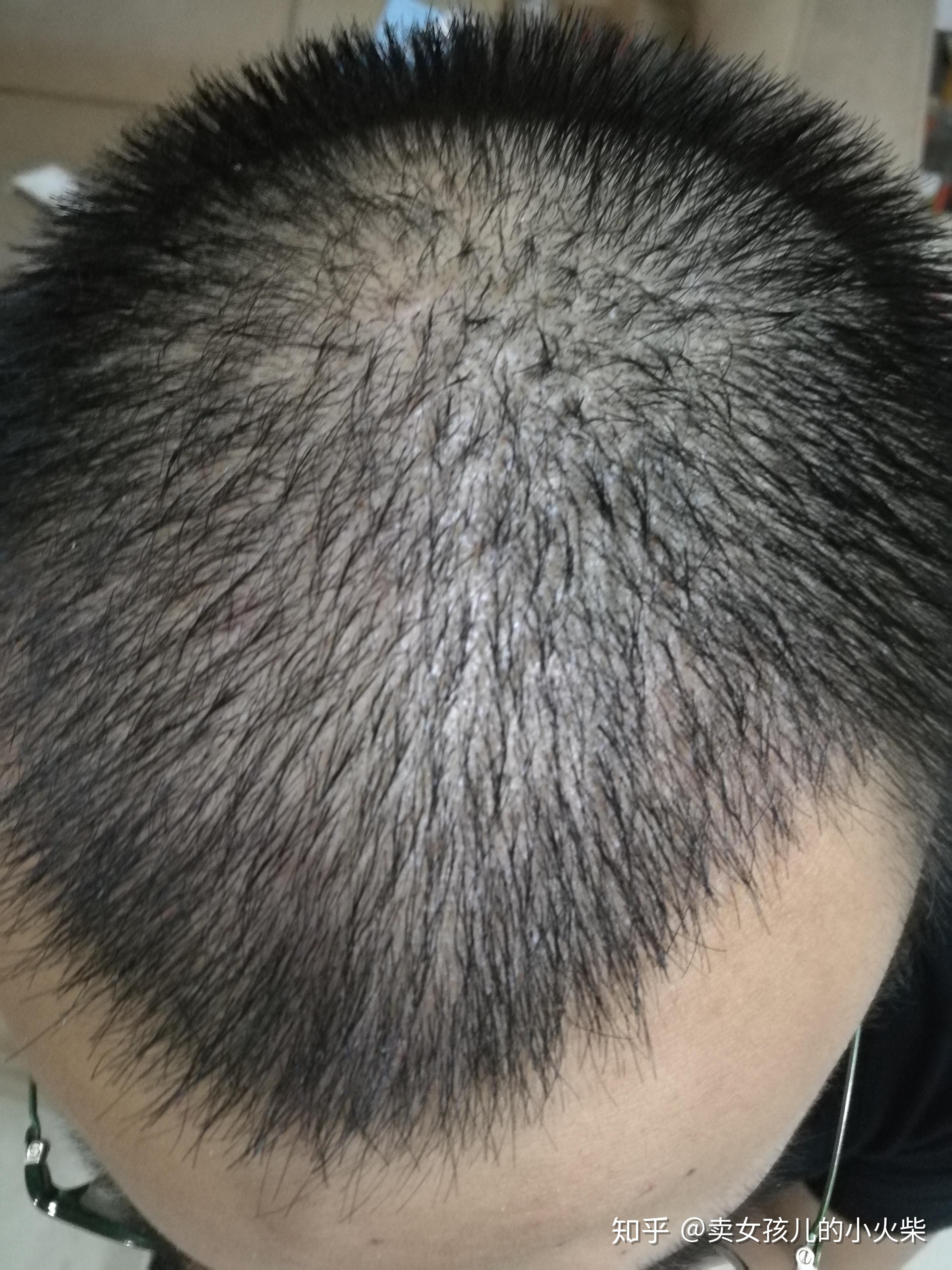 植发后表现(植发过后有什么后遗症)