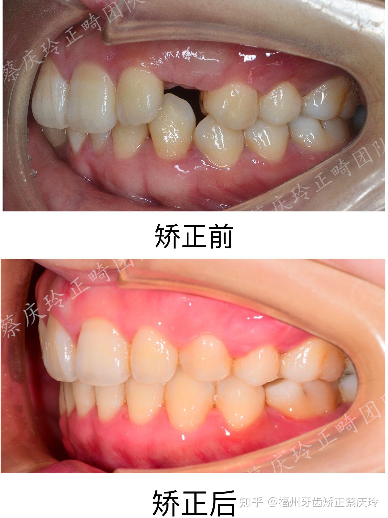 蔡庆玲正畸团队缺牙深覆合案例