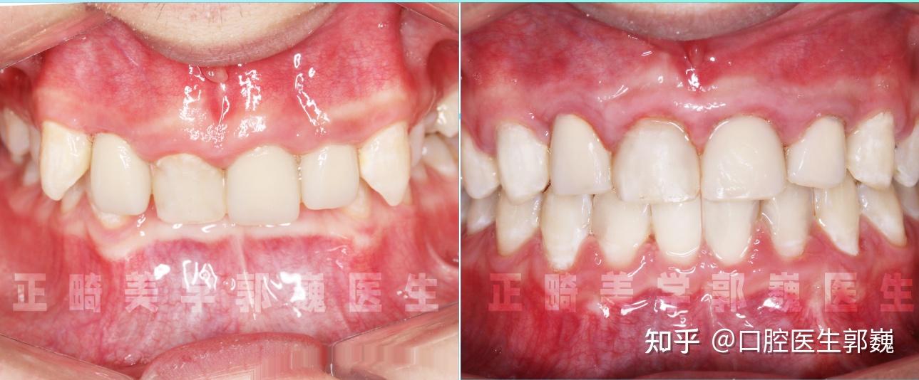 内倾型深覆合 - 知乎