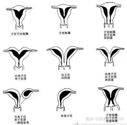 发生不良的妊娠结局,比如胎位不正,早产,胎盘前置,胎盘早剥,胎盘粘连