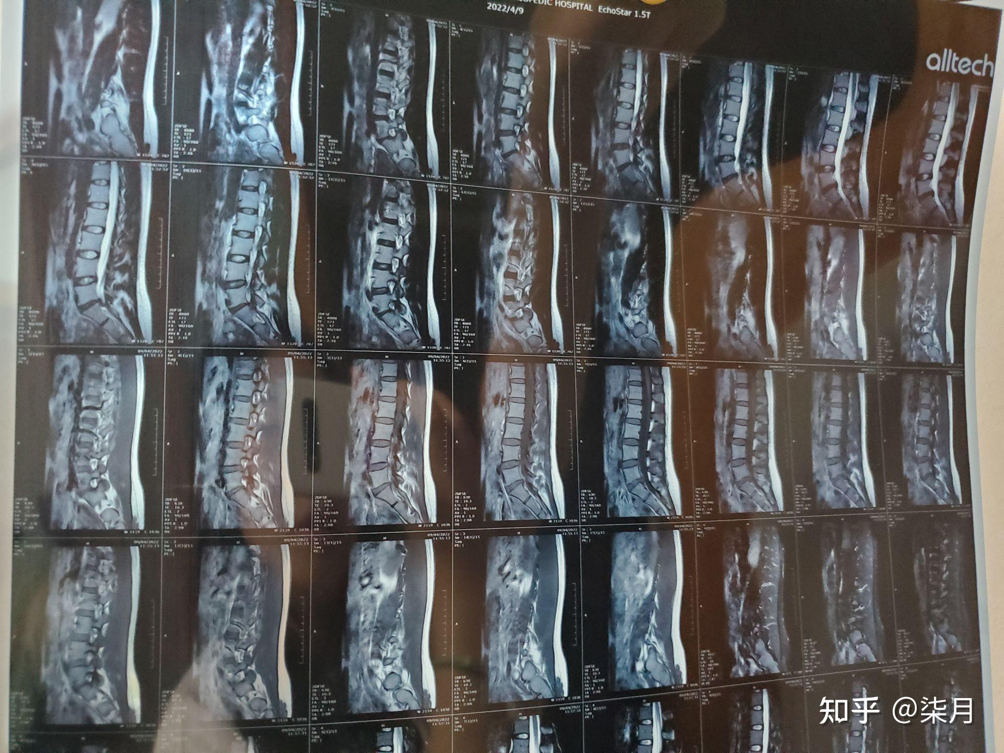 26岁,腰椎间盘脱出?