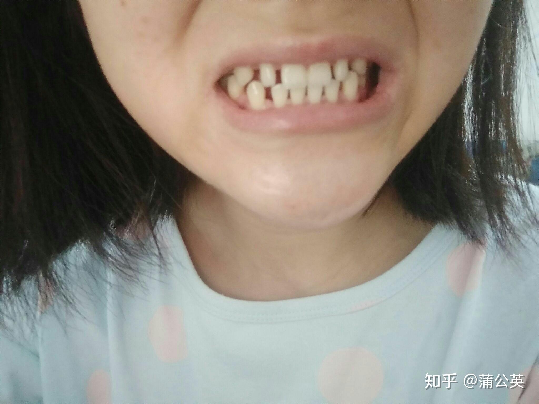 牙齿单个牙齿牙龈图片素材-编号33037139-图行天下