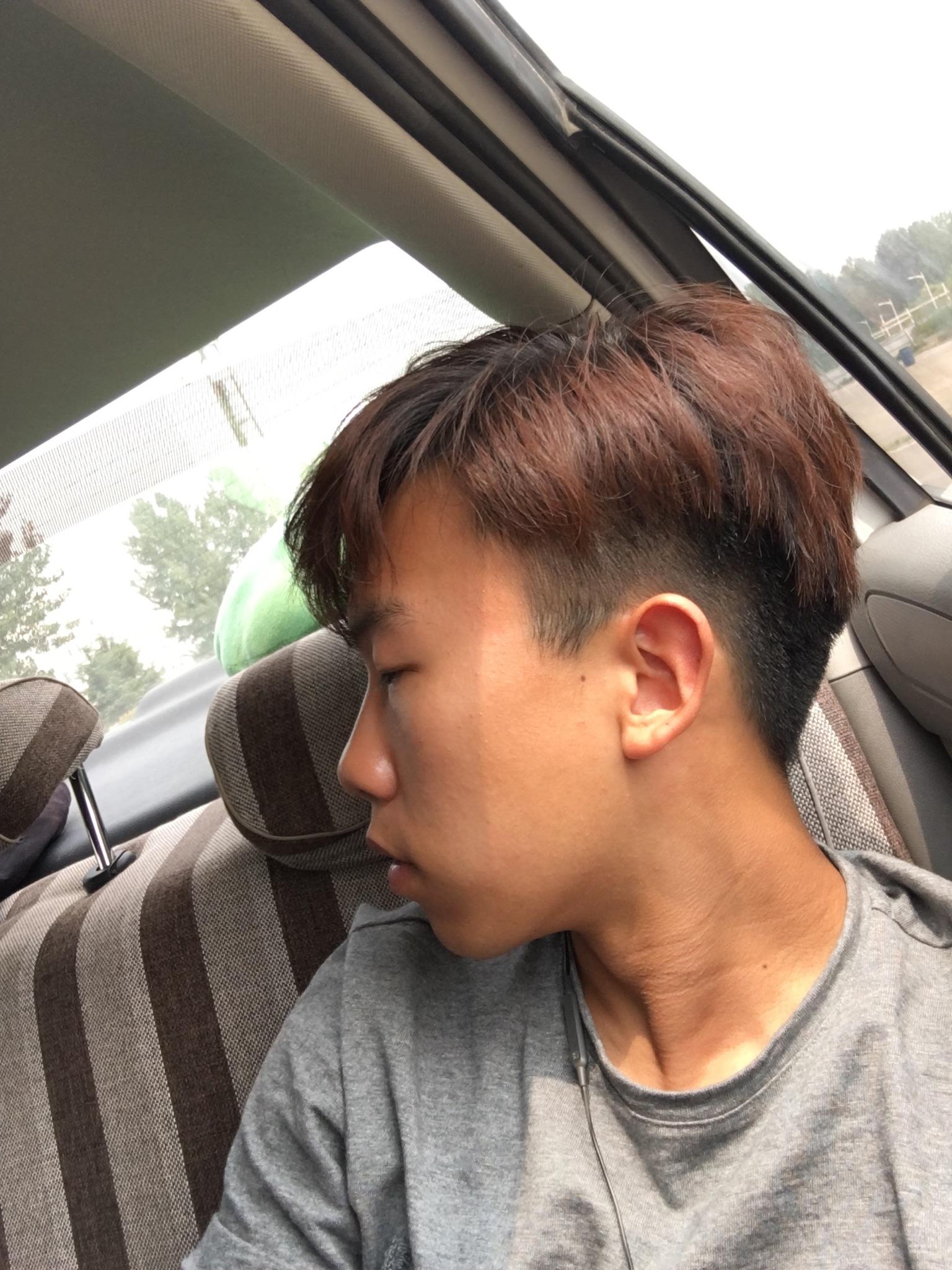 龅牙凸嘴怎么改善侧脸