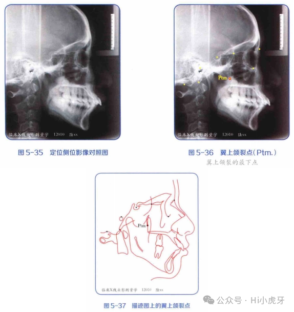 《临床X线 头影测量学》读书笔记(五)——常用头颅定位侧位影像测量标志点 - 知乎