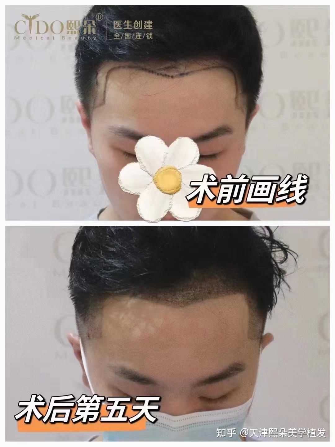 水富医院植发(哪里有植发的专业医院)