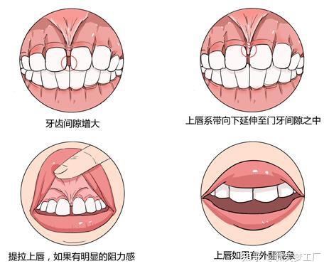 唇系带畸形的矫正