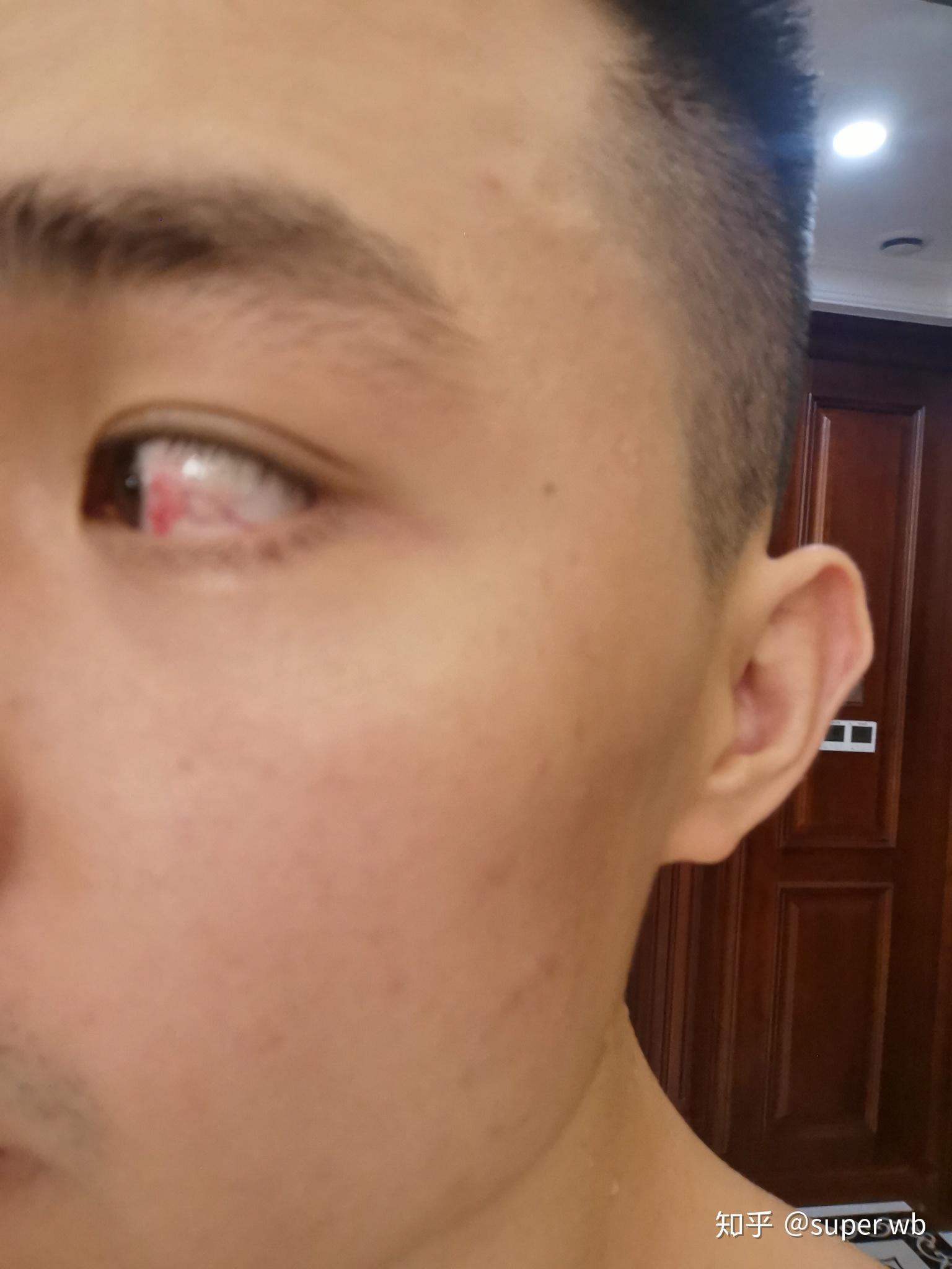 眼球打球被手指戳了有血块问题严重吗怎么消除血块