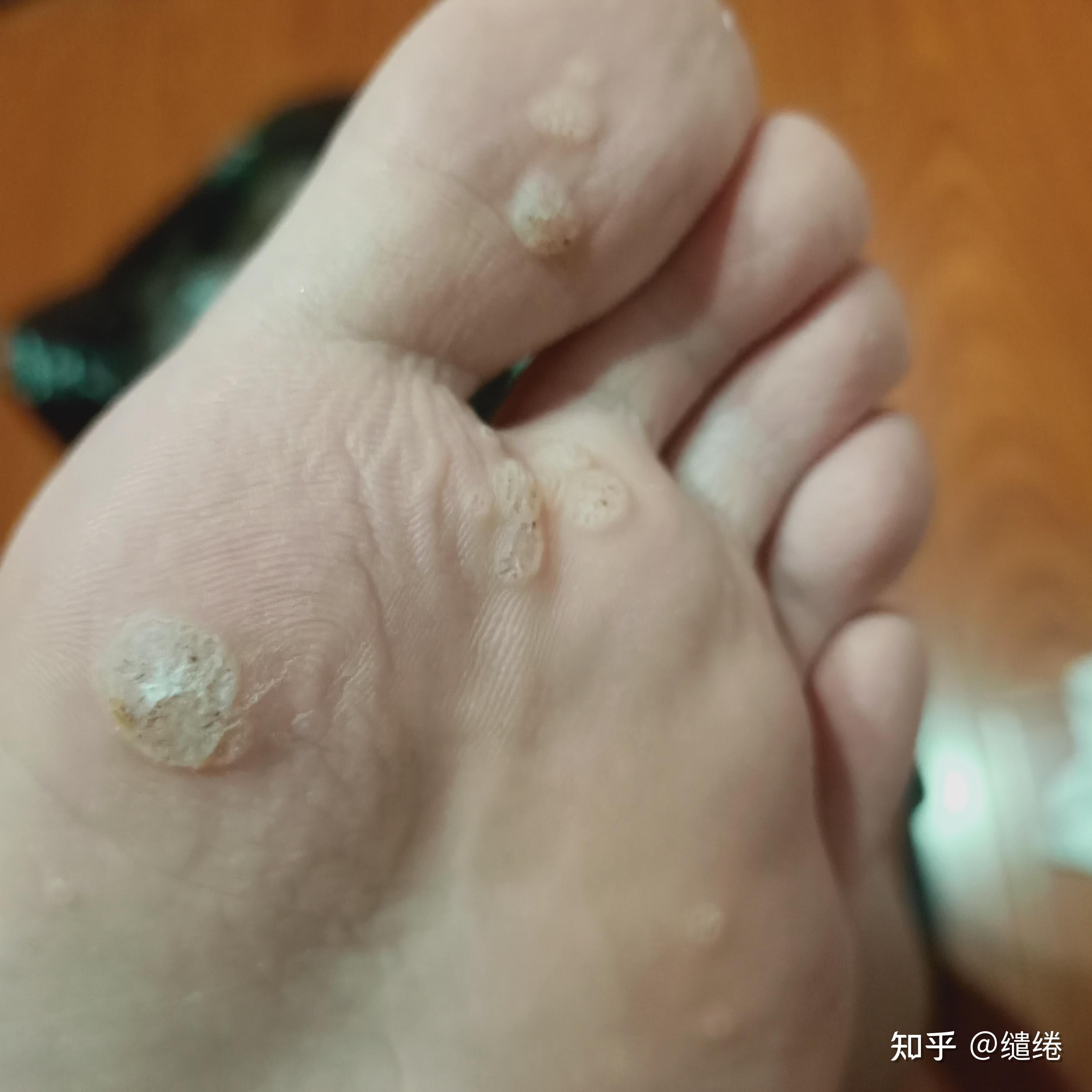 长了5年跖疣了我是不是要和跖疣过一辈子了哇