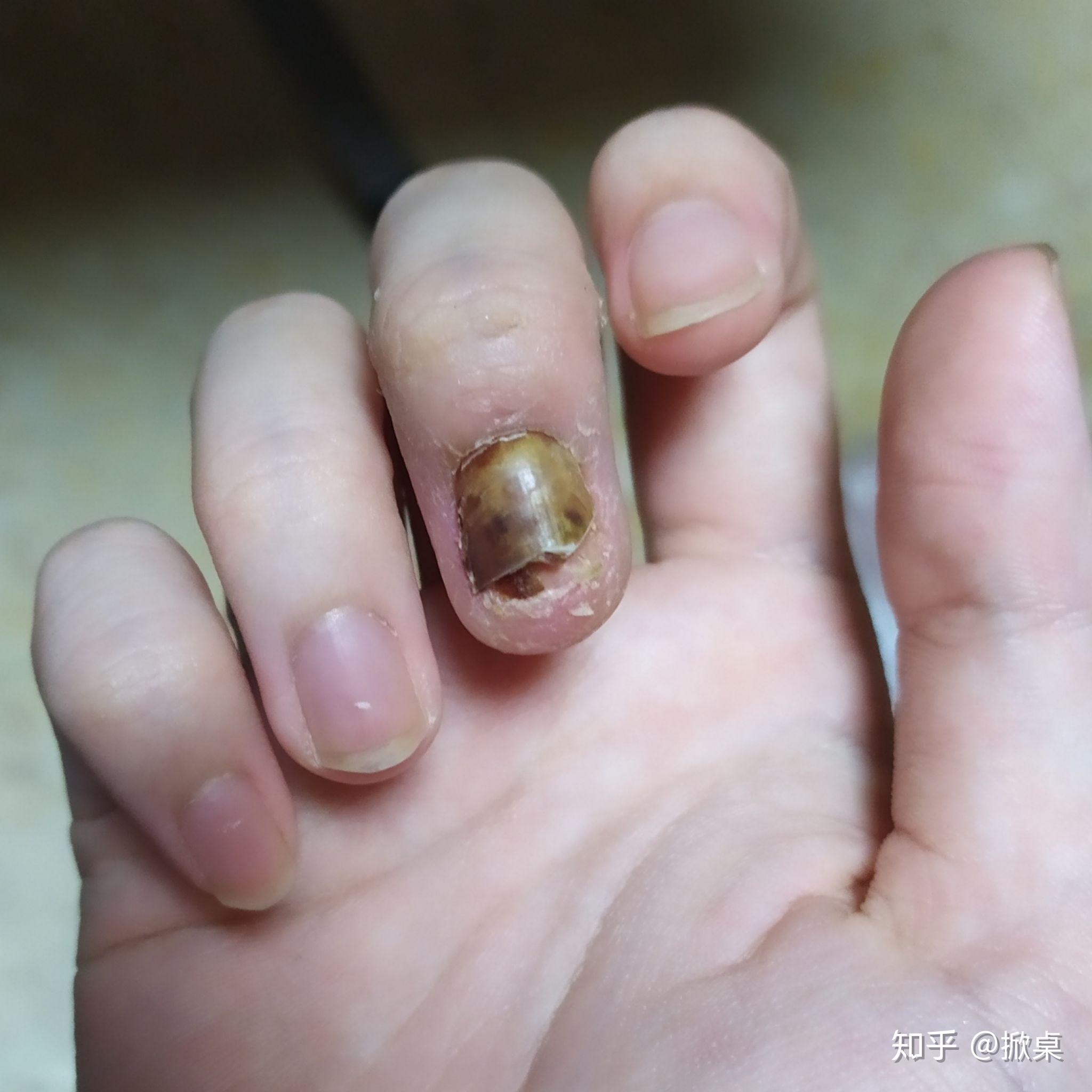 手指被门夹伤后的康复过程记录 