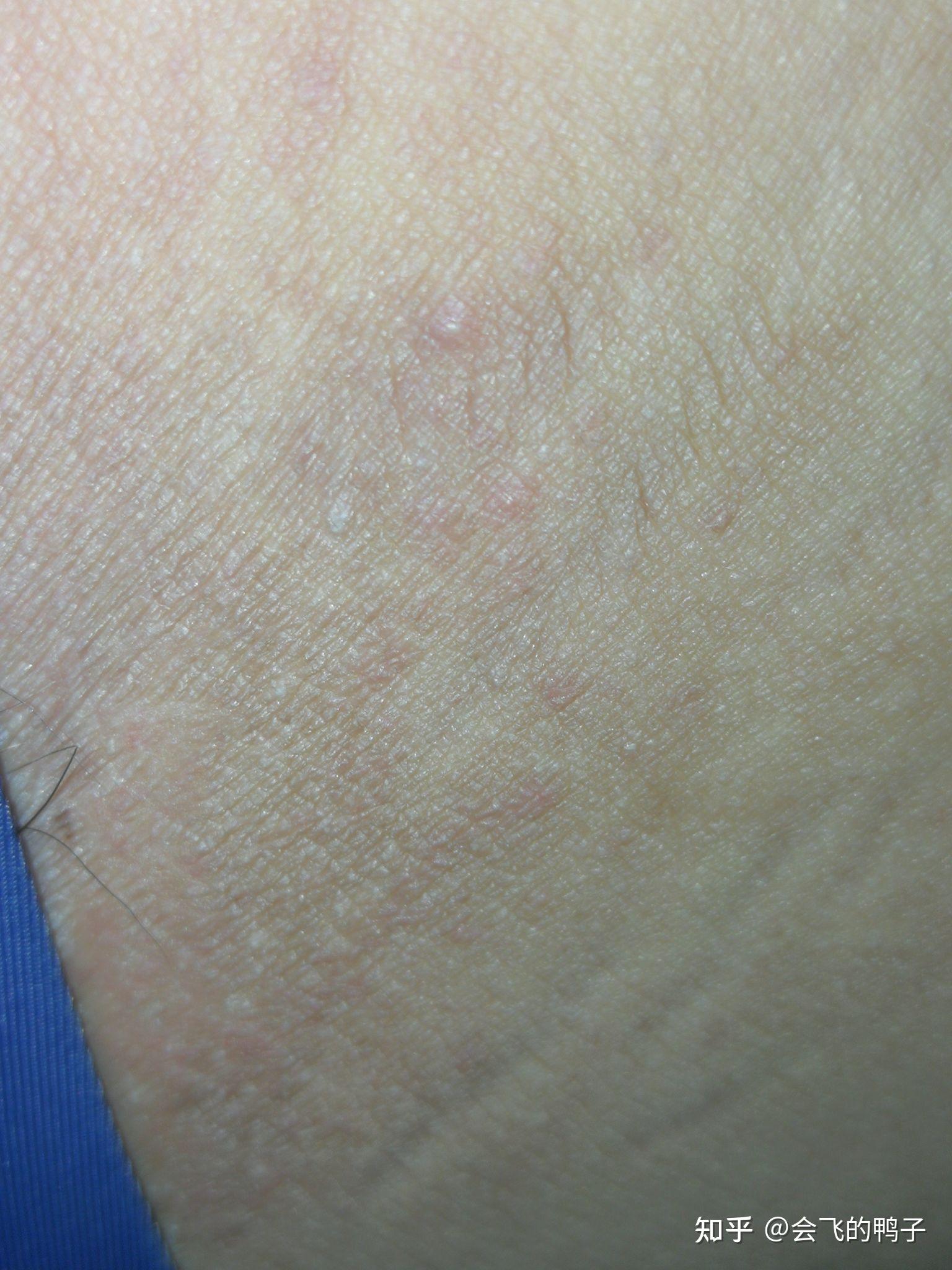 手臂皮肤上最近起了好几块一片一片像痱子似的小颗粒，不疼偶尔痒_痱子_邻医网