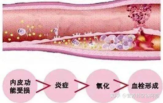 “血管硬化”4个真相,知道1个就能救命!再忙也要看一眼 - 知乎