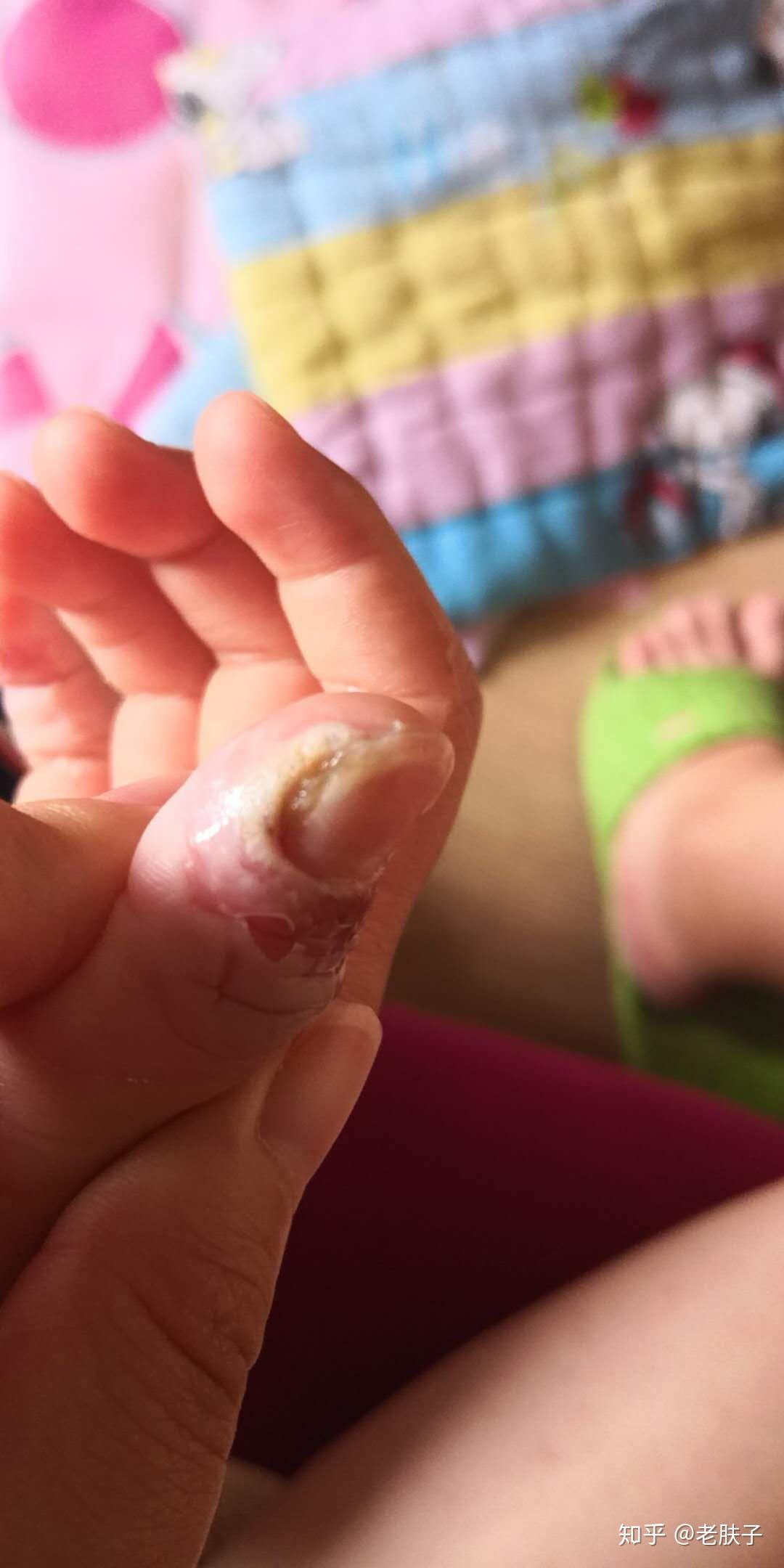 甲周疣怎么办 - 知乎