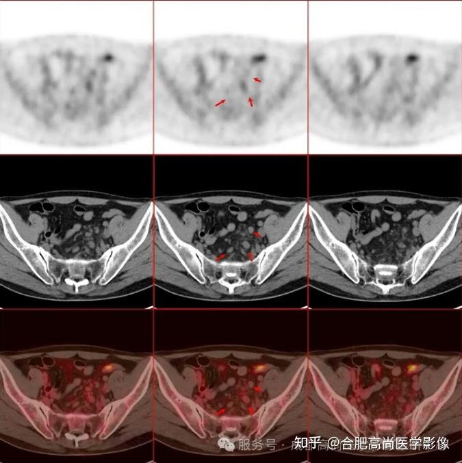47岁男大便不成形发现直肠腺癌,18F-FDG PET/CT联合HR-MR评估全身情况 - 知乎
