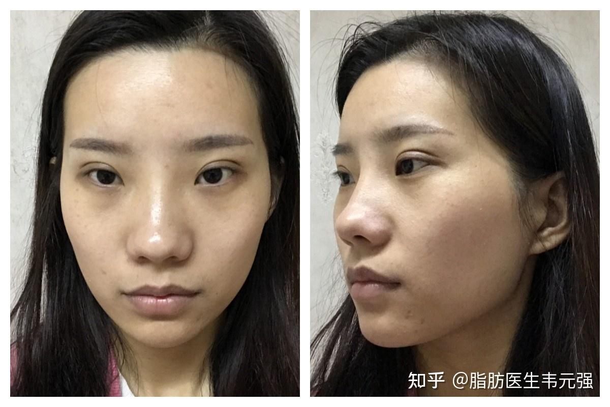 反颌？中上面部凹陷？25岁姑娘挑战全鼻改造，60天后公开改善细节 - 知乎